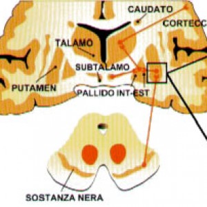 cervello parkinson